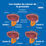 cancer-prostate