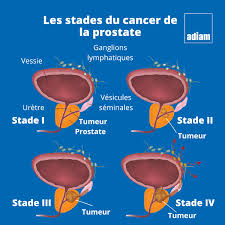 cancer-prostate